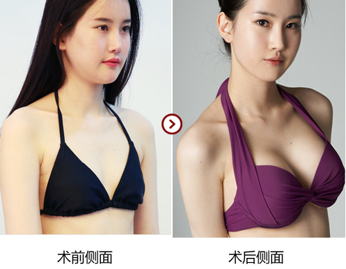 28年吸脂经验杭州美莱栗勇医生告诉你:吸脂要避开女性的经期