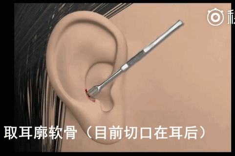 重庆华美是正规的吗?重庆华美整形医院隆鼻方案全过程