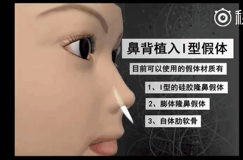 重庆华美是正规的吗?重庆华美整形医院隆鼻方案全过程