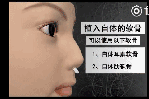 重庆华美是正规的吗?重庆华美整形医院隆鼻方案全过程