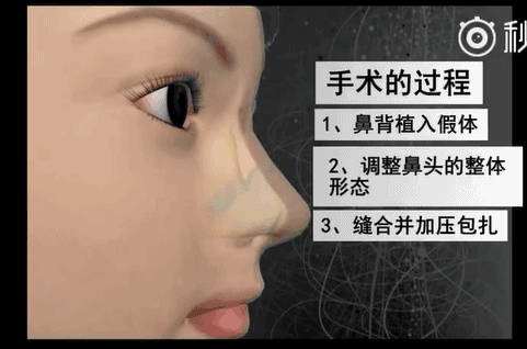 重庆华美是正规的吗?重庆华美整形医院隆鼻方案全过程