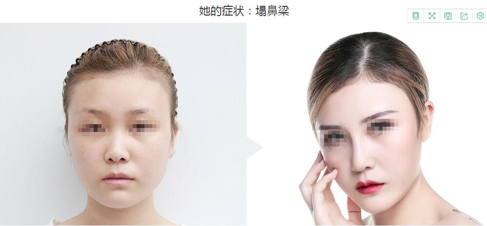 重庆华美是正规的吗?重庆华美整形医院隆鼻方案全过程