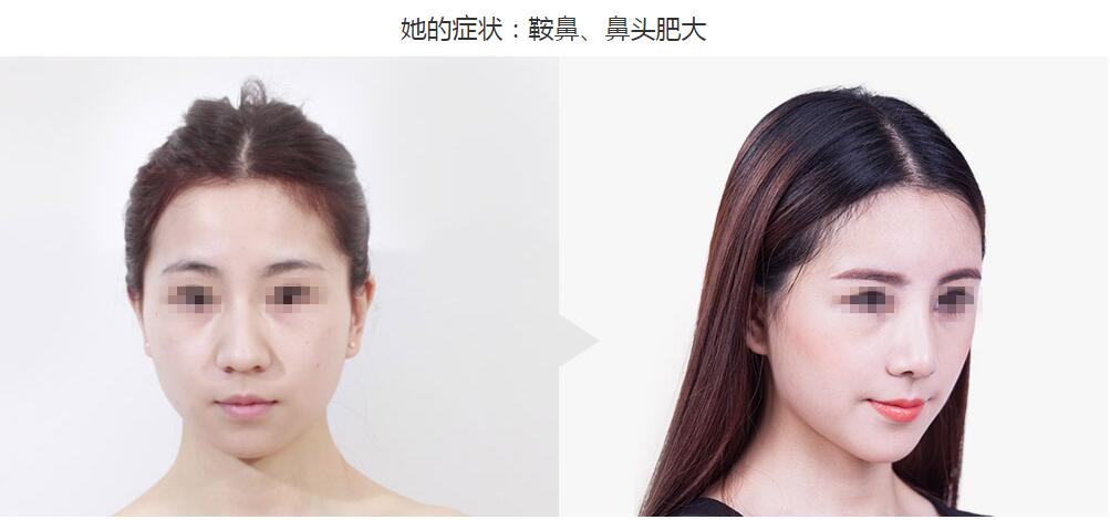 重庆华美是正规的吗?重庆华美整形医院隆鼻方案全过程