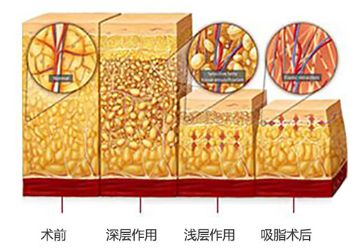 杭州时光吕敏医生告诉你，定向吸脂术是什么?