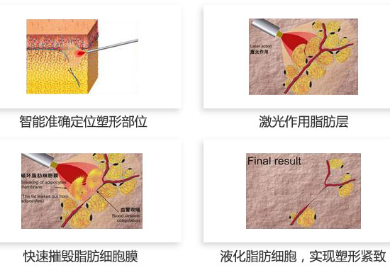 杭州时光吕敏医生告诉你，定向吸脂术是什么?
