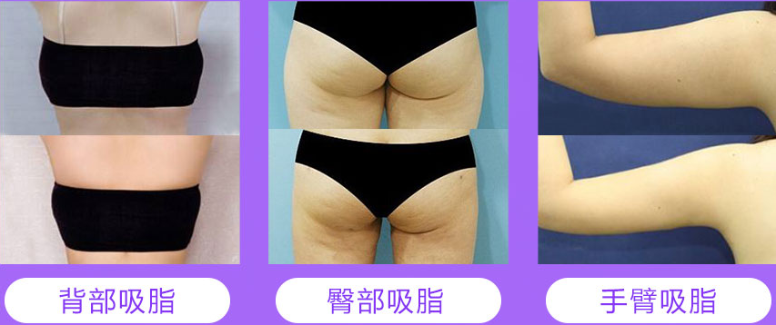 杭州时光吕敏医生告诉你，定向吸脂术是什么?