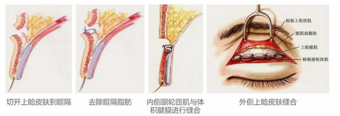 眼部整形需要注意什么?重庆军科整形零创动态8度美眼或许更好