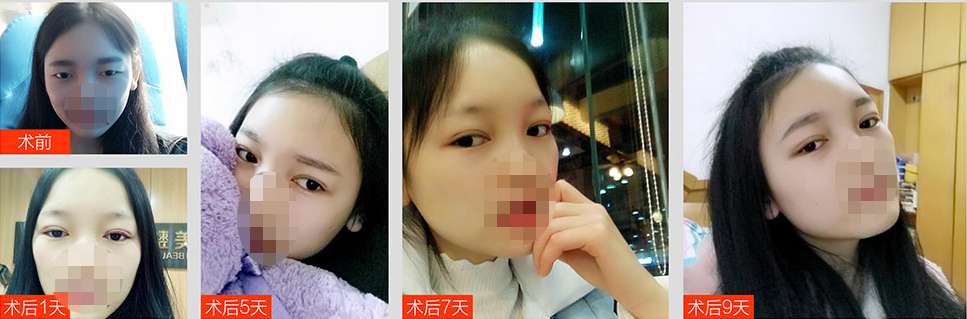 眼部整形需要注意什么?重庆军科整形零创动态8度美眼或许更好