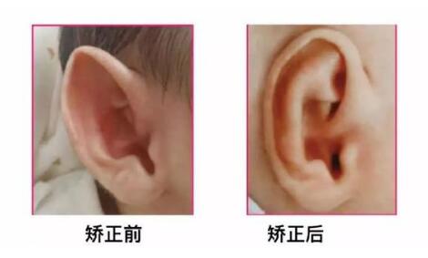 年龄不同宝宝矫正招风耳的方法也是不同,附全面矫正招风耳方法