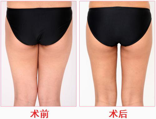 南京米尚恩水柔吸脂:一次改善女性肥胖问题