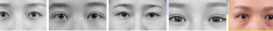 上海华美采用显微分型技术修复双眼皮,术后效果好并且无痕自然