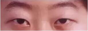 想做双眼皮手术，能说说眼睛整形后的形状吗?