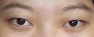 想做双眼皮手术，能说说眼睛整形后的形状吗?