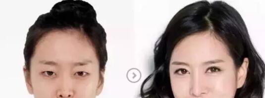 想做双眼皮手术，能说说眼睛整形后的形状吗?