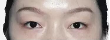 想做双眼皮手术，能说说眼睛整形后的形状吗?