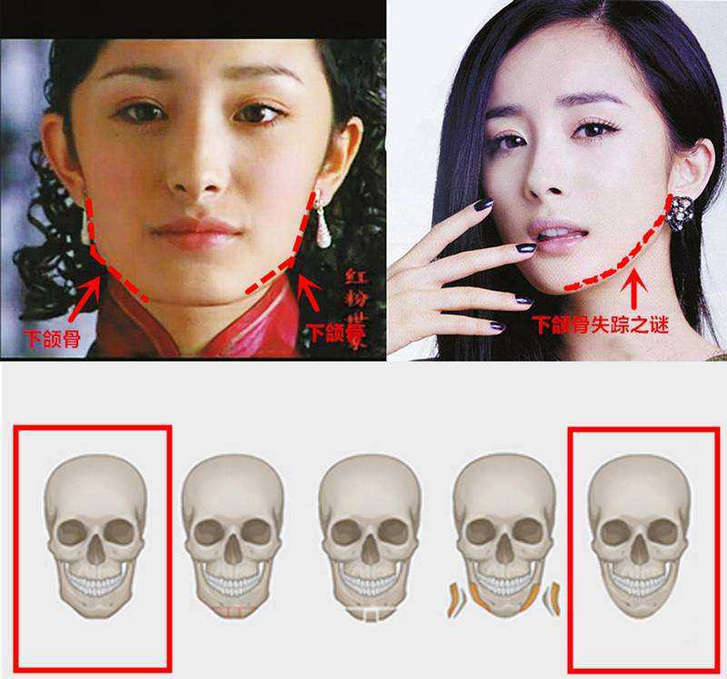 武汉美莱徐国建: 不是所有整形医院可以做磨骨手术......