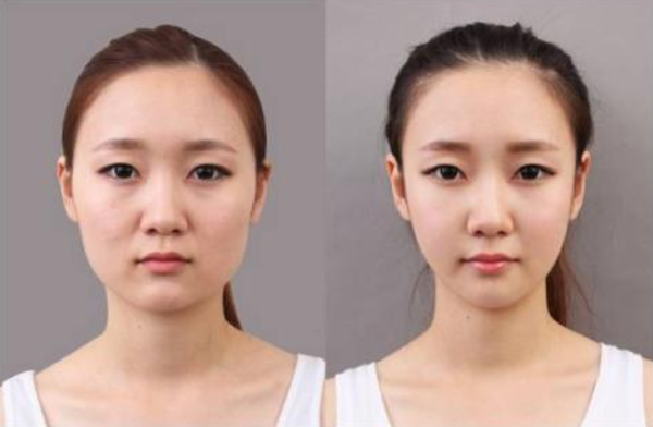 武汉美莱徐国建: 不是所有整形医院可以做磨骨手术......