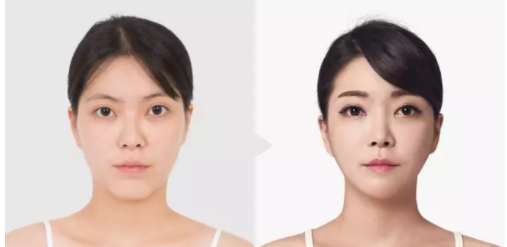 深圳广美整形王天国医生：其实99%的人都不懂颧骨缩小和磨骨的