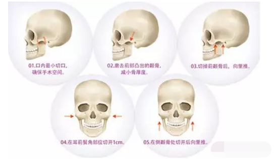 深圳广美整形王天国医生：其实99%的人都不懂颧骨缩小和磨骨的