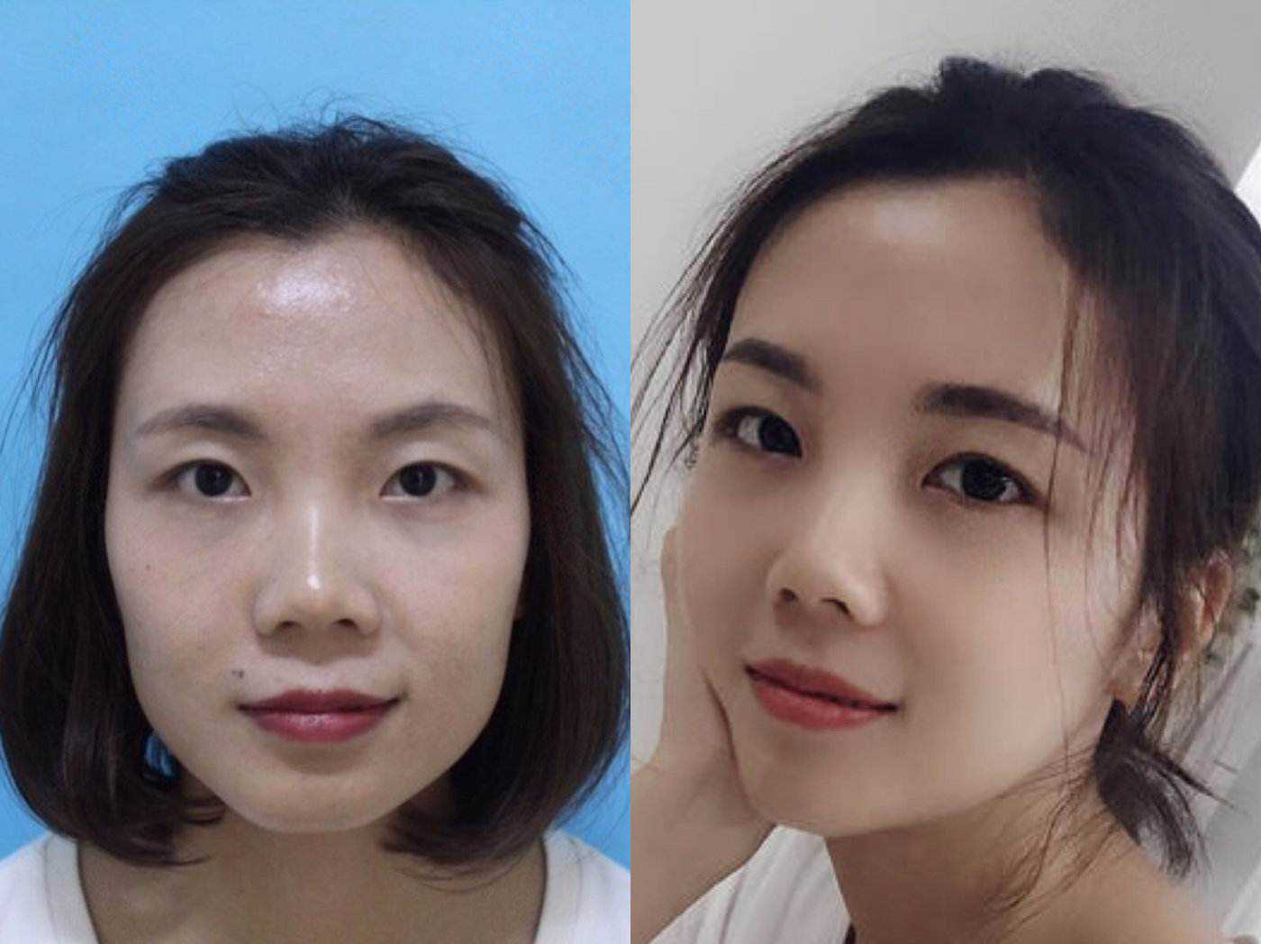 厦门莫琳娜整形医院—崔起荣医生解读瘦脸*和磨骨瘦脸的区别