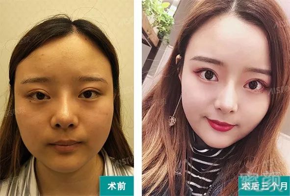 削骨安全还是磨骨安全?附做完削骨磨骨手术后的效果及感受
