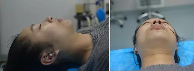 南宁美丽焦点院长好吗?焦俊光鼻整形技术_手术风格_术后效果图
