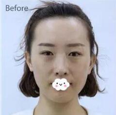 石家庄美联臣翟彦刚医生做双眼皮怎么样?多少钱?附案例效果