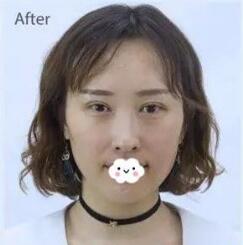 石家庄美联臣翟彦刚医生做双眼皮怎么样?多少钱?附案例效果