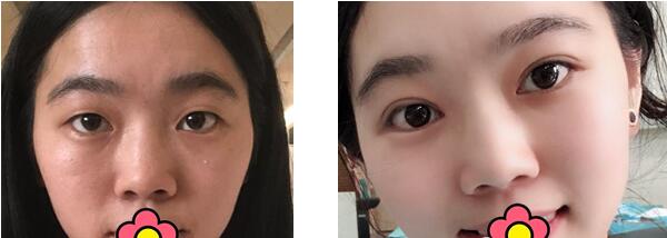 成都华美邱伟医生祛眼袋割双眼皮怎么样?邱伟整形技术效果评价
