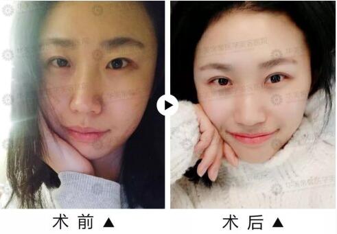 成都华美陈杨主任做鼻综合、纳米美眼昨样?陈杨案例效果图费用
