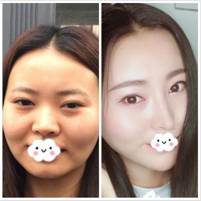 成都华美陈杨主任做鼻综合、纳米美眼昨样?陈杨案例效果图费用