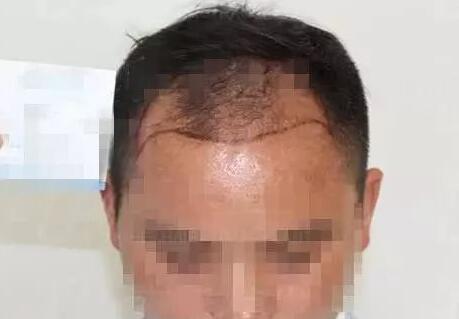 成都雍禾李丙双植发技术怎么样?李丙双治疗脱发案例效果图价格