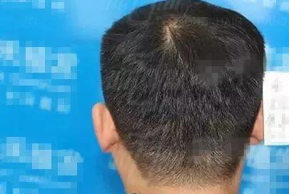 成都雍禾李丙双植发技术怎么样?李丙双治疗脱发案例效果图价格