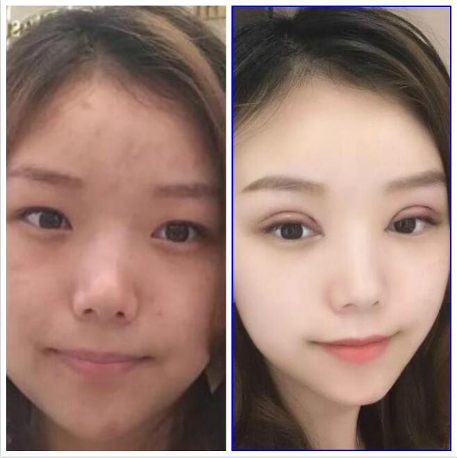 成都艾米丽潘红伟怎么样?潘红伟脂肪填充(抽脂)双眼皮案例效果