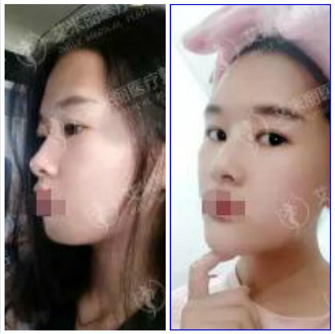成都艾米丽潘红伟怎么样?潘红伟脂肪填充(抽脂)双眼皮案例效果