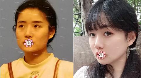 成都娇点姜宇禄院长口碑怎样?姜宇禄磨骨隆鼻丰胸案例效果价格