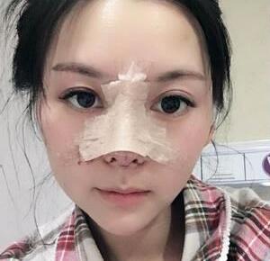 成都蓉城周鼻子怎么样?周仪鼻整形案例效果图及手术风格_价格