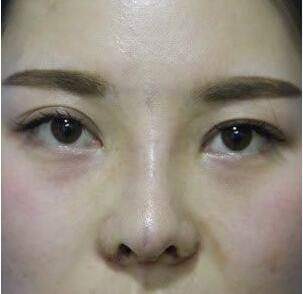 成都蓉城周鼻子怎么样?周仪鼻整形案例效果图及手术风格_价格