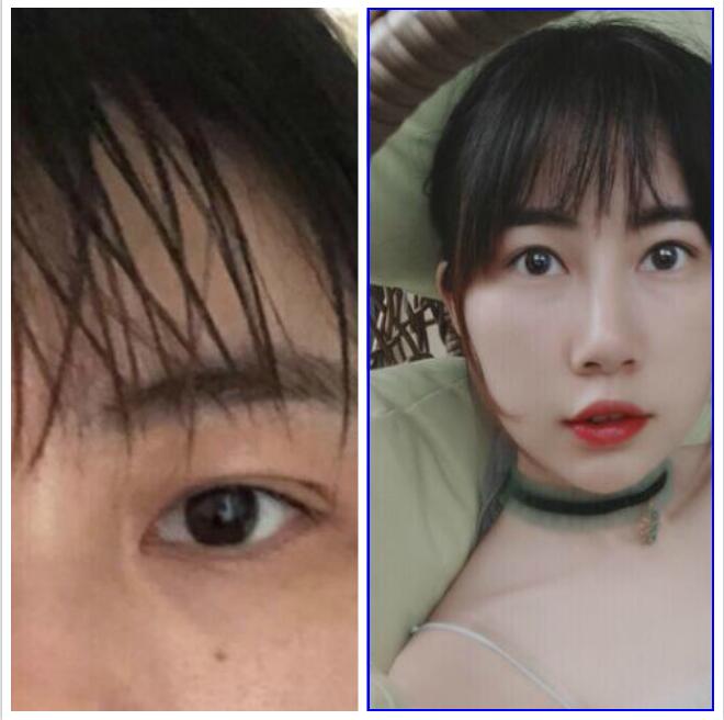 肿泡眼可以做抽脂手术吗?上海华美做眼部吸脂手术大概多少钱