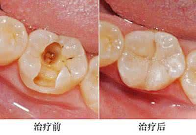 上海华美补牙做的怎么样?做补牙手术的时候会不会很痛?