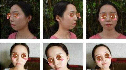 上海九院磨骨医生有哪些?哪位医生做磨骨好?