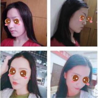 上海九院磨骨医生有哪些?哪位医生做磨骨好?