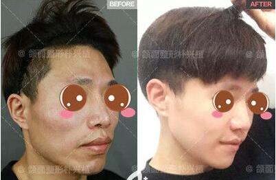上海首尔丽格做男士磨骨手术怎么样?术后效果好吗?