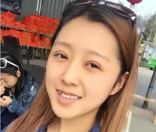 成都铜雀台杨建医生眼睛整形怎么样?杨建双眼皮案例恢复过程图