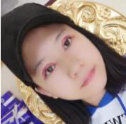 嘉兴曙光医院王艳双眼皮开得好?附王艳医生双眼皮案例效果图及价格
