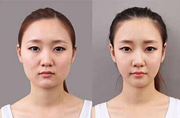 嘉兴禾美医院正规吗?禾美整形好附医生案例效果图及价格表