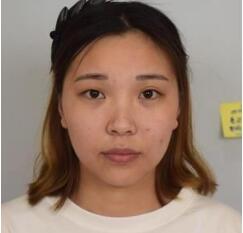 找嘉兴禾美周宇丹开双眼皮怎么样?周宇丹院长整形技术_手术风格_案例效果_价格