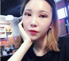 找嘉兴禾美周宇丹开双眼皮怎么样?周宇丹院长整形技术_手术风格_案例效果_价格