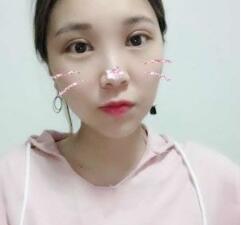 找嘉兴禾美周宇丹开双眼皮怎么样?周宇丹院长整形技术_手术风格_案例效果_价格
