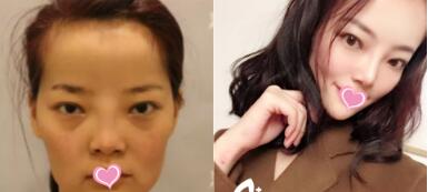 上海九院韦敏擅长填充泪沟不?想知道上海九院做泪沟脂肪填充效果好的专家